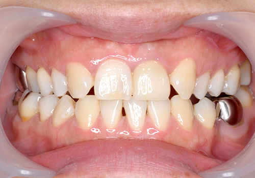 ひかりのテラス歯科クリニックプラスのセラミック症例