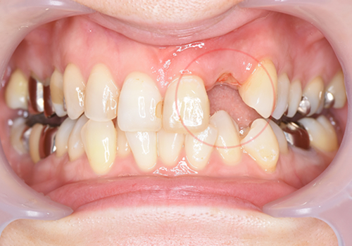 ひかりのテラス歯科クリニックプラスのセラミック症例