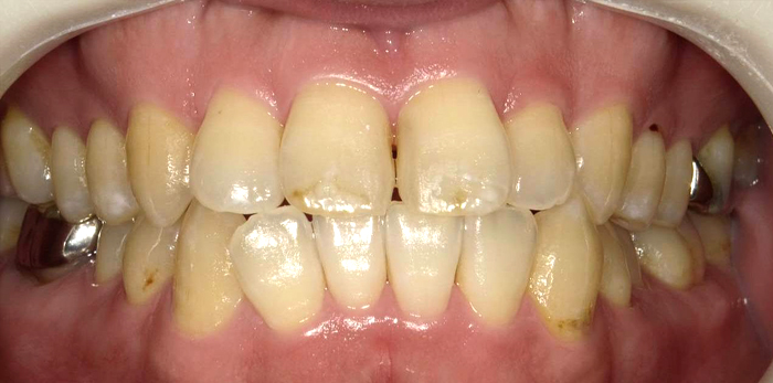 ひかりのテラス歯科クリニックプラスのホワイトニング症例