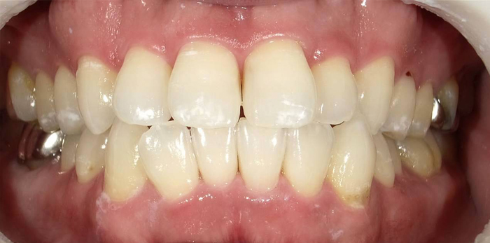ひかりのテラス歯科クリニックプラスのホワイトニング症例